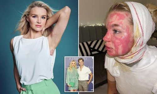 Accident-left-AJ-Pritchardaposs-girlfriend-Abbie-with-horrifying-burns.jpg