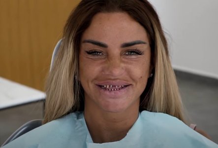 Katie-Price-teeth-without-crowns-1024x695.jpg