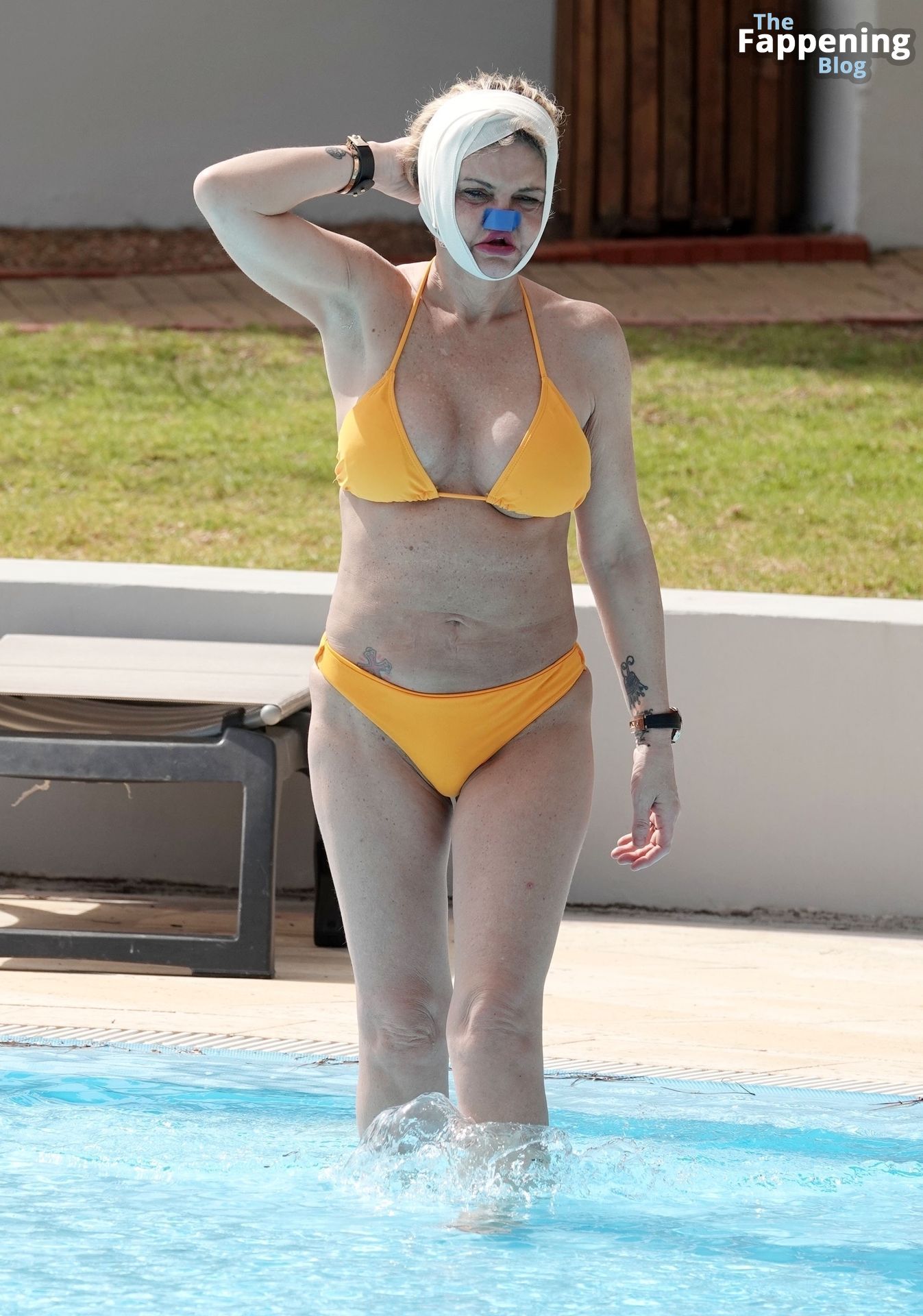 Danniella Westbrook Sunbathes with Bandages Around Her Head and Nose Out in Turkey (47 Photos)